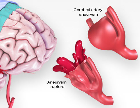 cerebral aneurysm