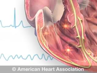 arrhythmia