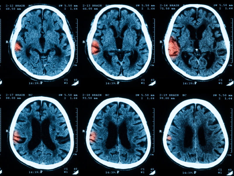 CT scan of brain, Intracerebral hemorrhage